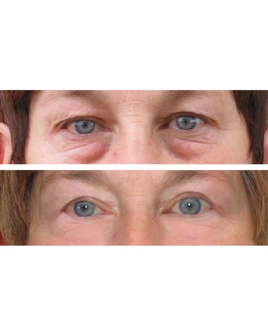 Predire Paris 50X Vitamin A Retinol Anti-Wrinkle & Intensive Rapid Renewal Eye Serum Set Women Skincare Treatments Predire Paris 50X Vitamin A Retinol Anti-Wrinkle & Intensive Rapid Renewal Eye Serum Set Women Skincare Treatments -Predire Paris Store 1111496731 RLLZ 2